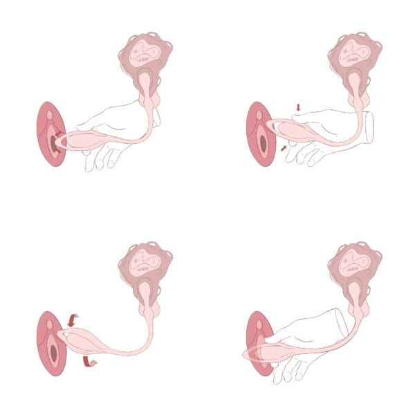 Explanatory illustrations showing UEROS vibrator positions and stimulation zones, schematic views against a light background.
